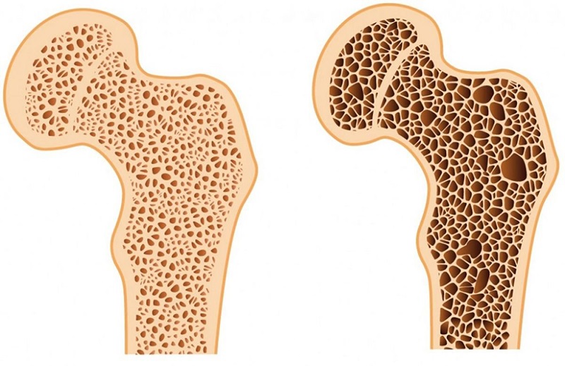  Cách điều trị bệnh loãng xương và những thông tin quan trọng bạn cần biết