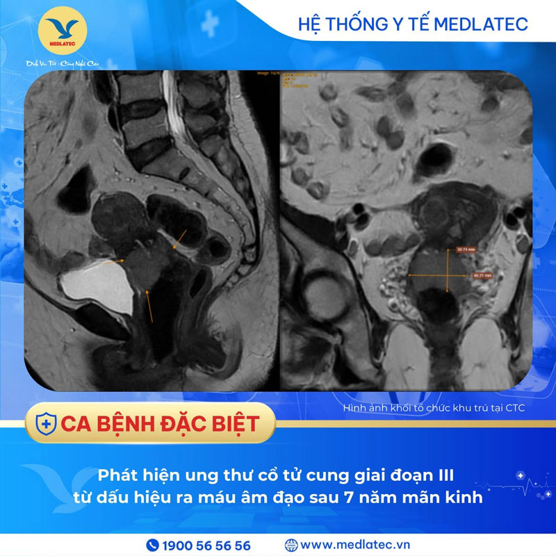 Hình ảnh MRI ung thư cổ tử cung giai đoạn III