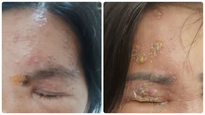Zona thần kinh ở mắt cần được điều trị để tránh biến chứng nguy hiểm