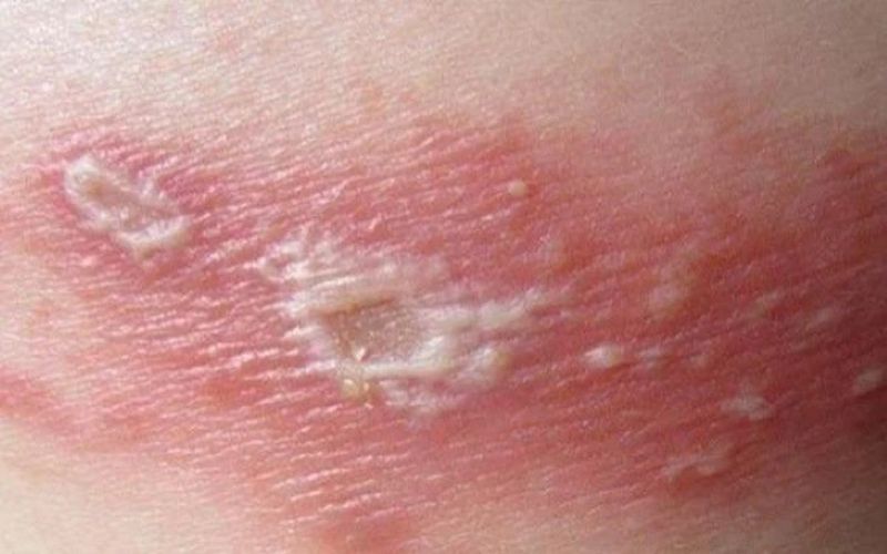 Các mụn nước do zona không được chăm sóc đúng cách có thể gây bội nhiễm tổn thương da