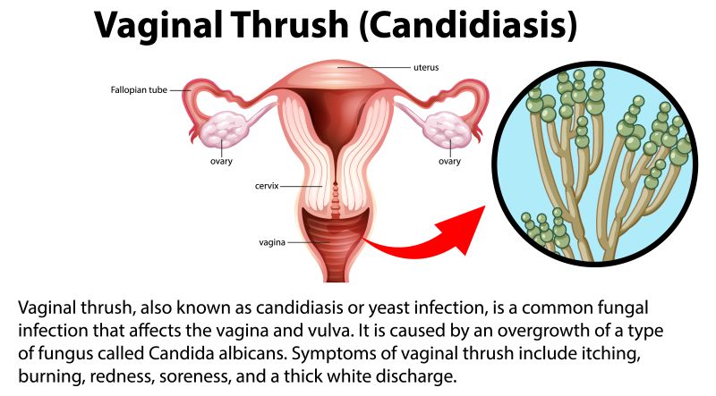 Nhiễm nấm Candida là một trong những nguyên nhân gây ngứa âm đạo