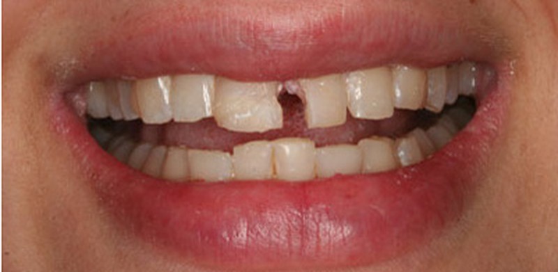 Các yếu tố nào ảnh hưởng đến sức khỏe và sự mỏng manh của men răng?
