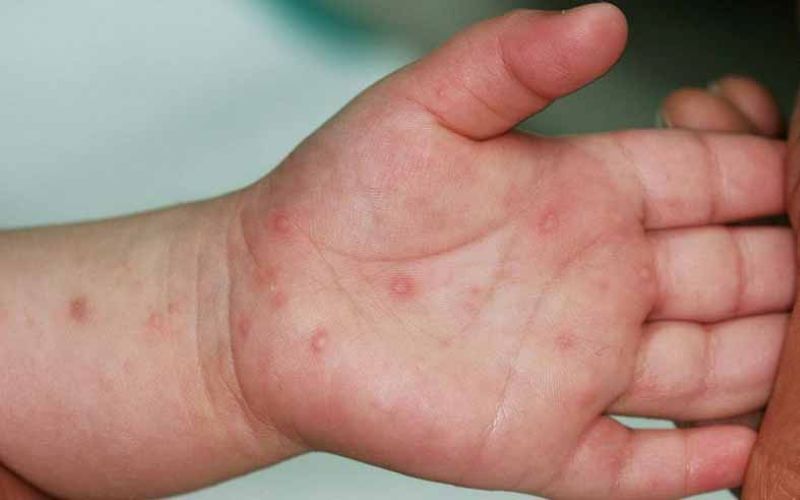 Các nốt tay chân miệng xuất hiện ở niêm mạc miệng, lòng bàn tay, bàn chân,..