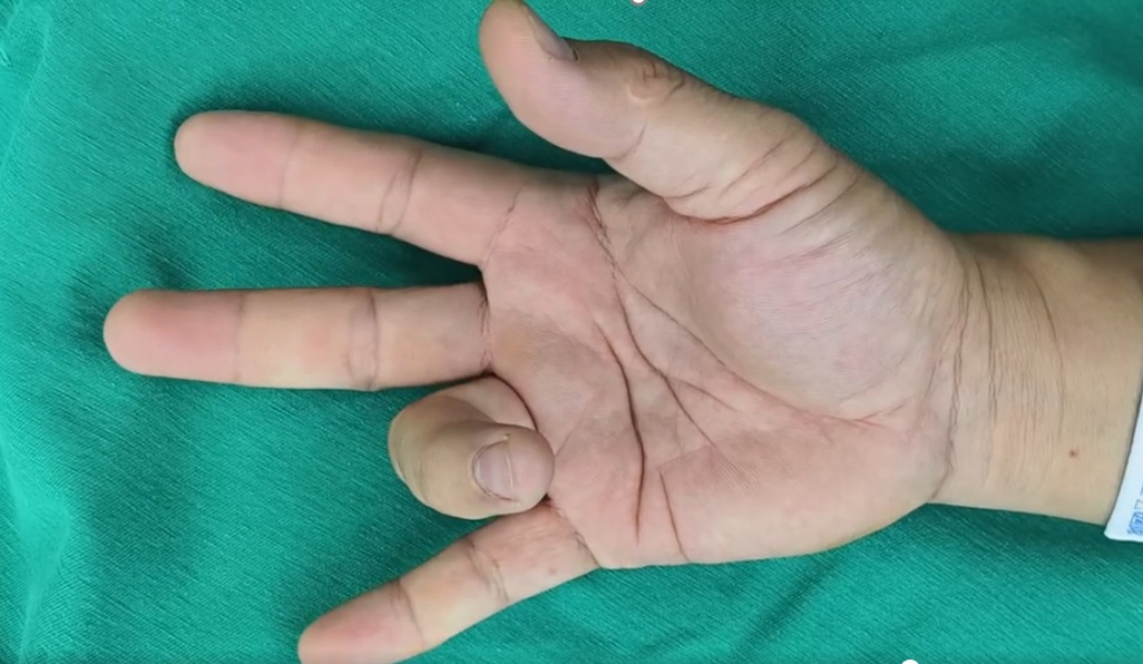 Ngón áp út của bệnh nhân không thể duỗi thẳng như các ngón tay khác 