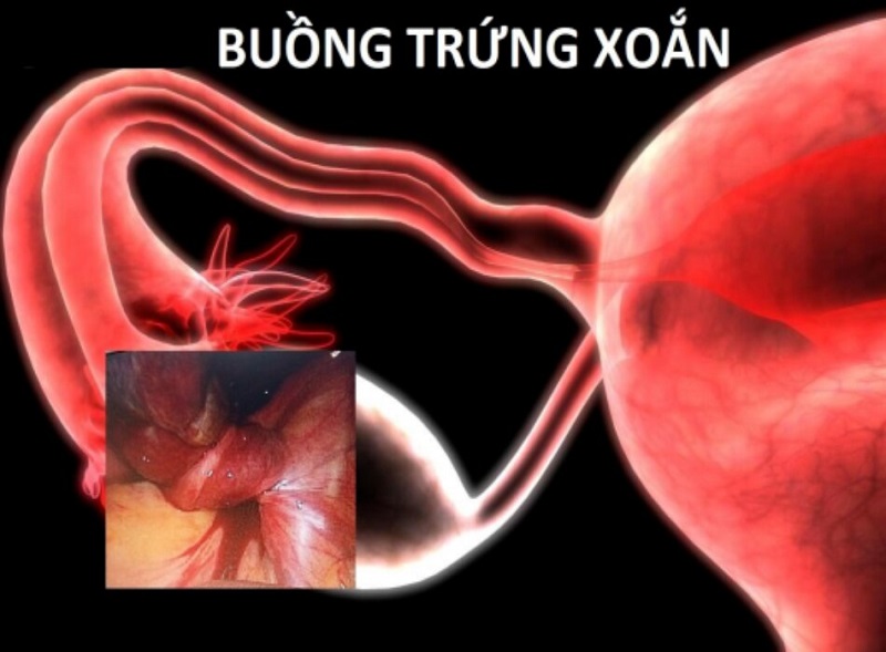 Xoắn buồng trứng có thể được chỉ định phẫu thuật