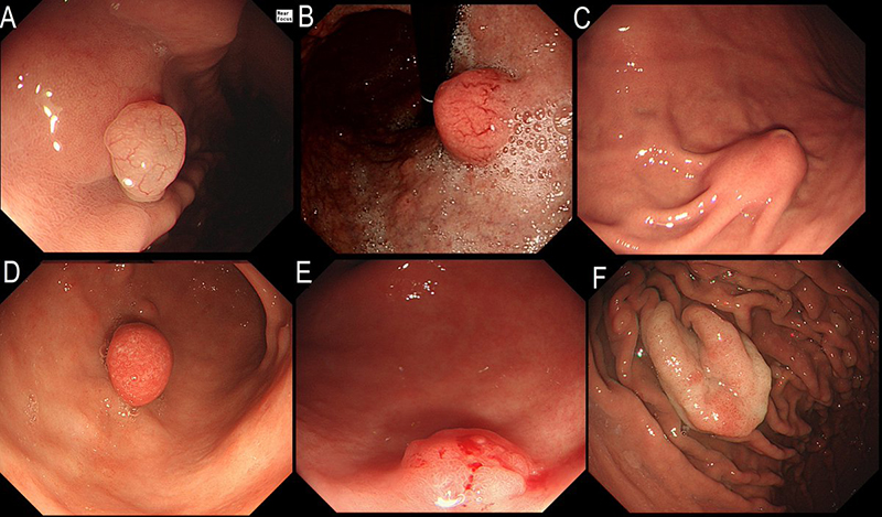 Polyp dạ dày