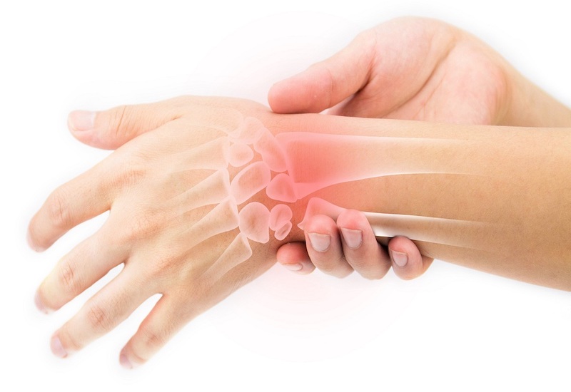 Các triệu chứng chính của hội chứng ống cổ tay là gì?
