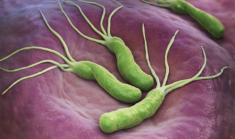 Nhiễm H.pylori kéo dài liên quan đến polyp tăng sinh và polyp tuyến
