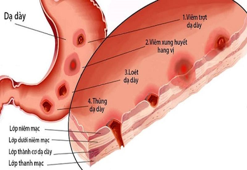 Hình ảnh minh họa thủng dạ dày