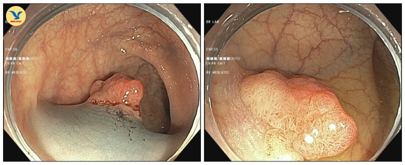 Polyp đại trực tràng