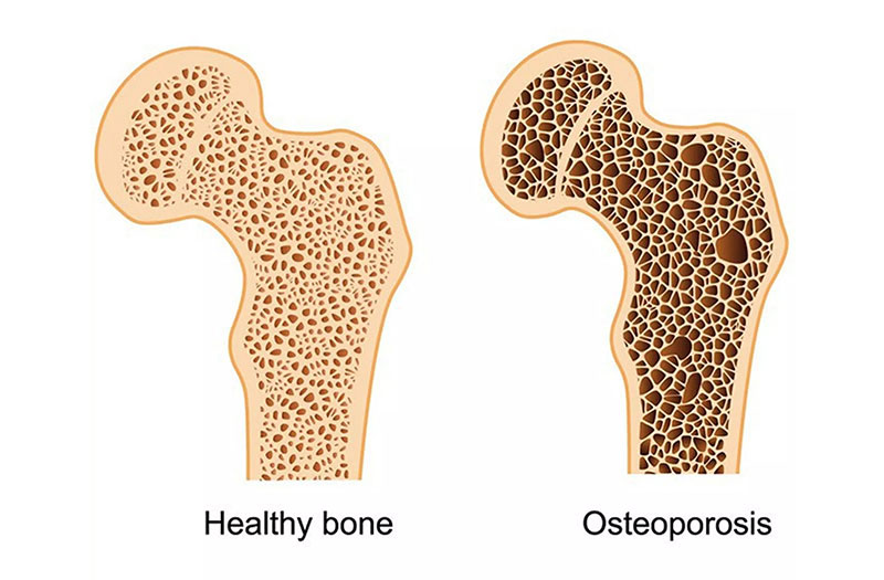 Bạn có biết? trọng lượng xương người được ảnh hưởng bởi nhiều yếu tố