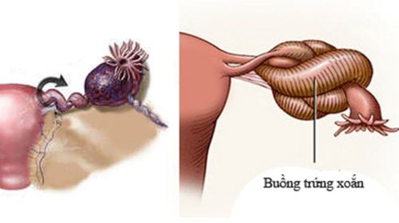 U quái buồng trứng có thể gây biến chứng nguy hiểm xoắn buồng trứng