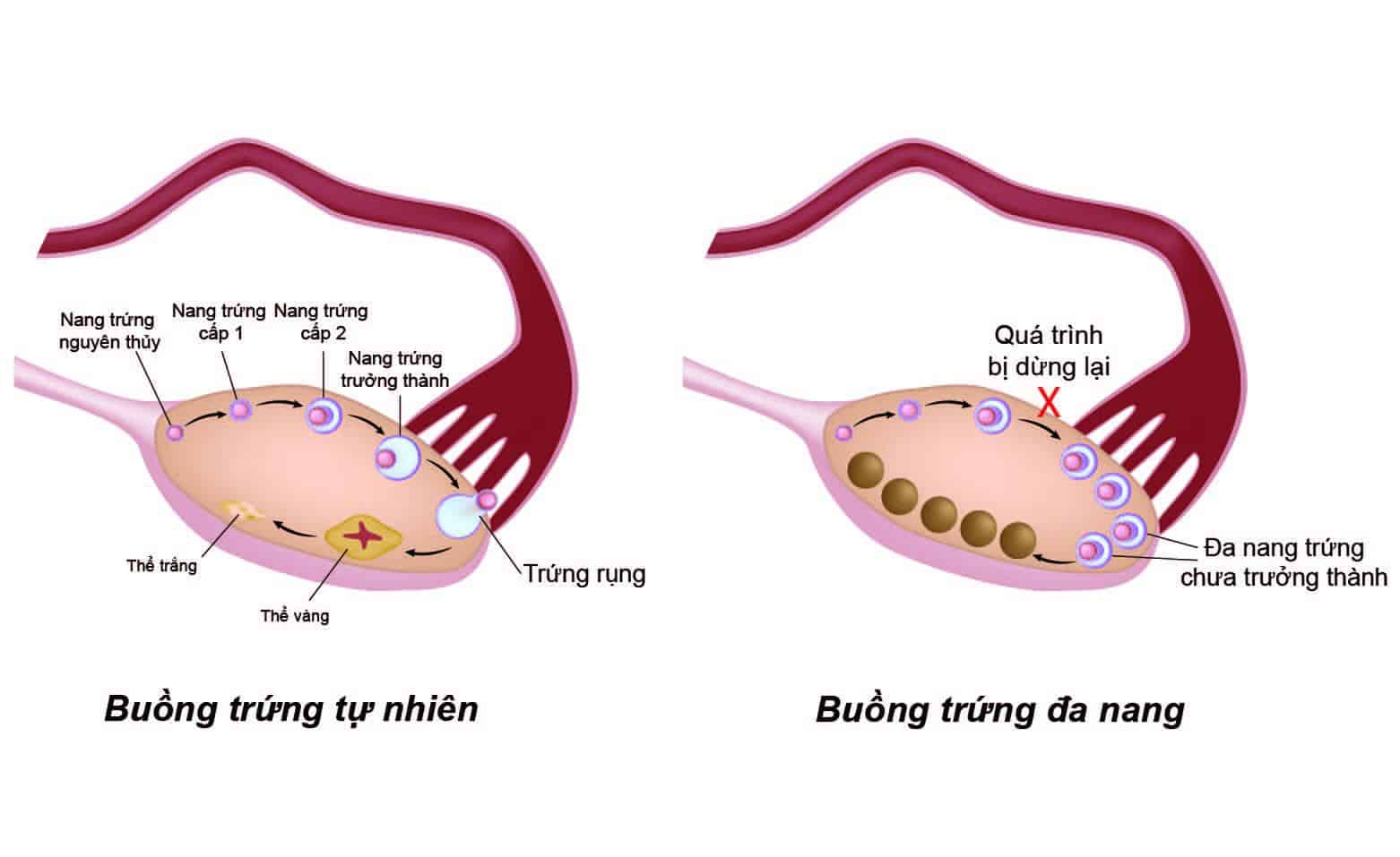 Phụ nữ buồng trứng đa nang nên bổ sung thực phẩm bổ trứng