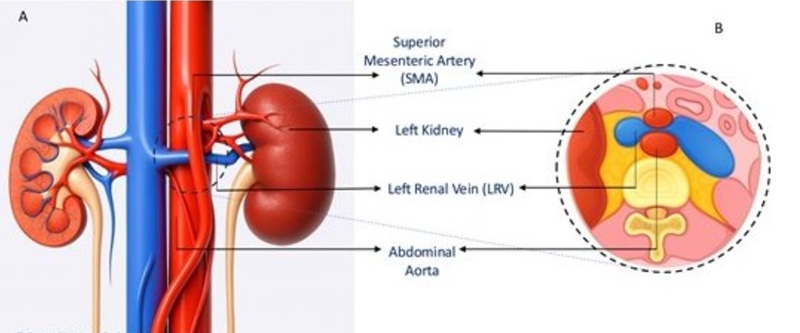Hội chứng kẹp hạt dẻ là tình trạng rất hiếm gặp trong y khoa. Ảnh minh họa