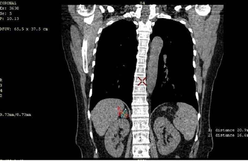 Bệnh nhân chụp CT phổi liều thấp phát hiện tổn thương tuyến thượng thận phải hình oval