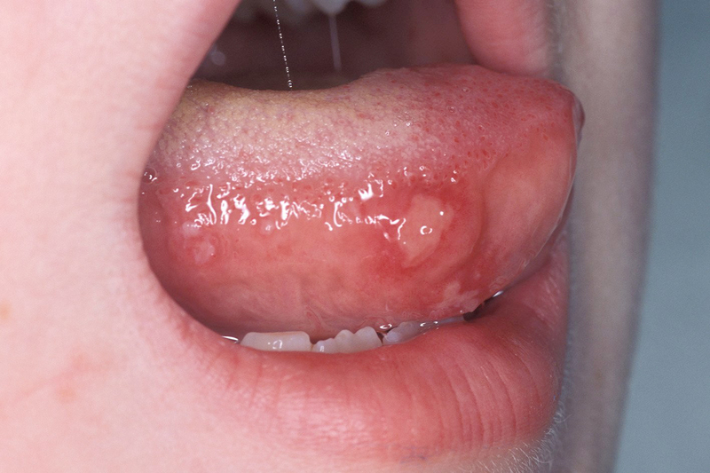 Tay chân miệng ở lưỡi