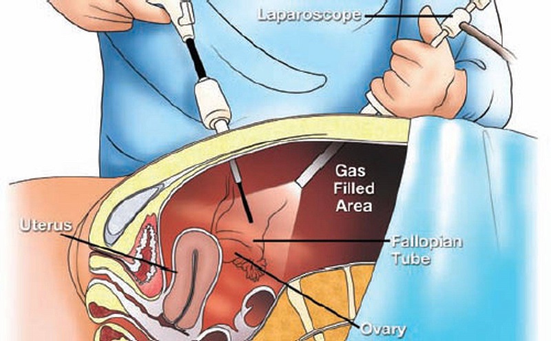 Các trường hợp cần thực hiện nội soi ổ bụng chẩn đoán?
