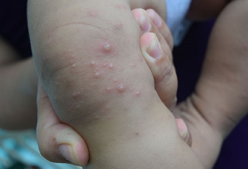 Trẻ mắc tay chân miệng thường nổi các nốt ban đỏ hoặc mụn nước nhỏ ở tại một số bộ phận trên cơ thể