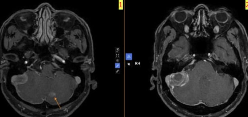 Hình ảnh tổn thương gợi ý ung thư di căn não trên hình ảnh phim chụp MRI sọ não