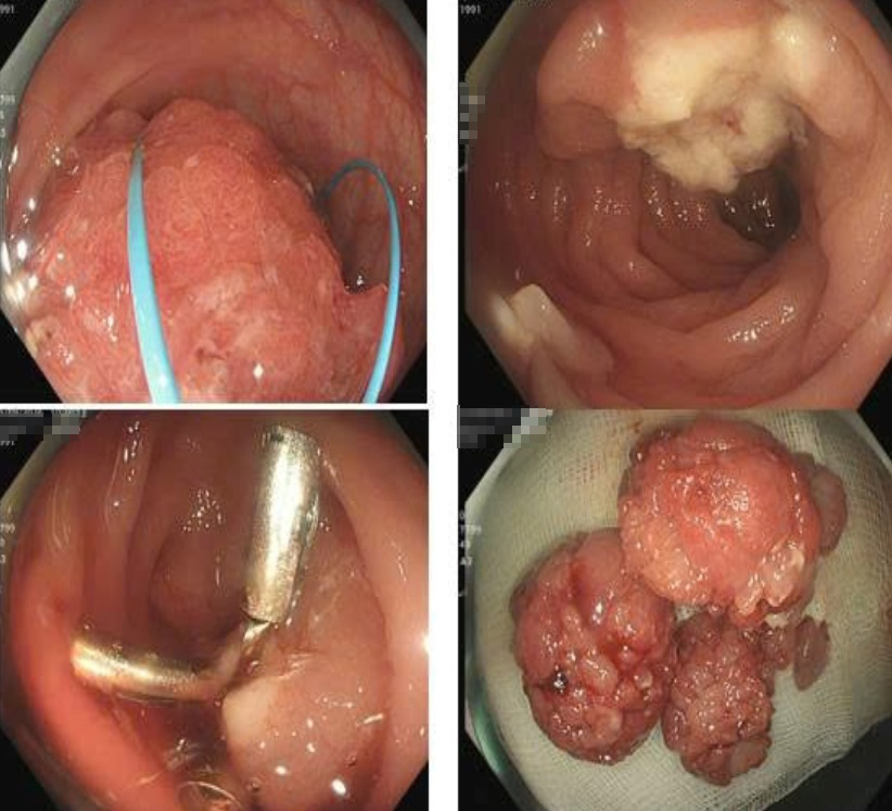 Hình ảnh nội soi phát hiện một polyp khổng lồ ở đại tràng sigma