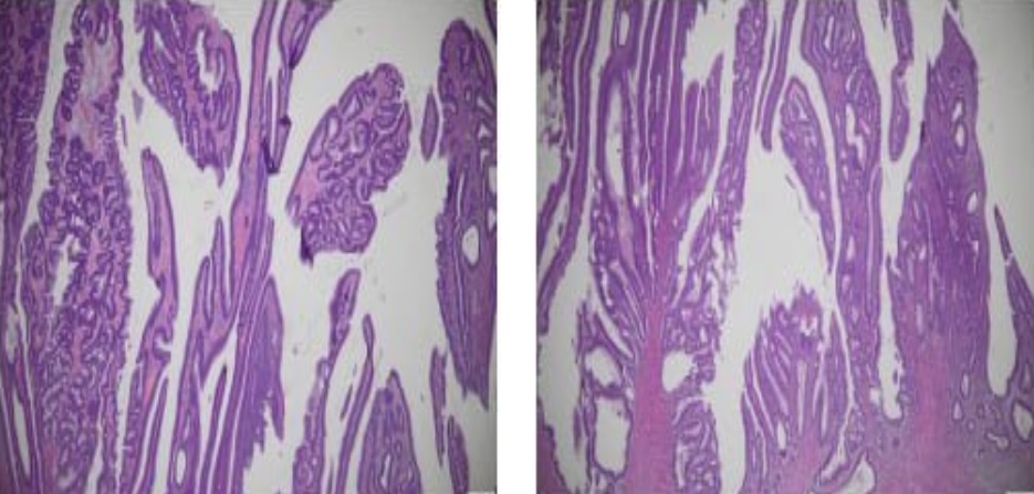Giải phẫu bệnh cho kết quả là polyp u tuyến ống - nhú loạn sản độ thấp