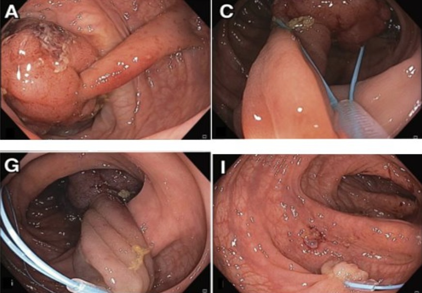 Polyp đại tràng được chia làm nhiều nhóm và có nhóm có khả năng tiến triển thành ung thư. Ảnh minh họa