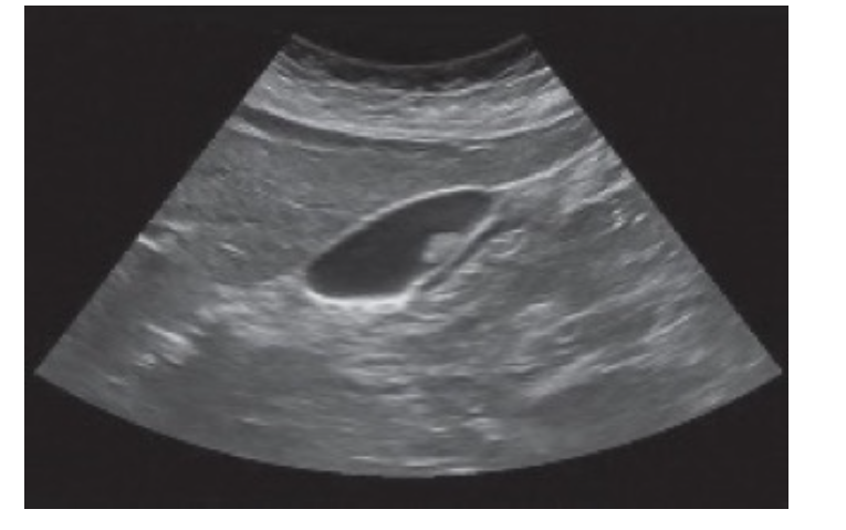 Hình ảnh siêu âm túi mật có polyp 