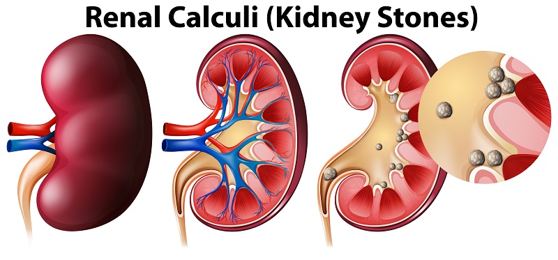 Một số bệnh lý có thể gây đau lưng, hông, tiểu buốt, khối phồng ở vùng bẹn