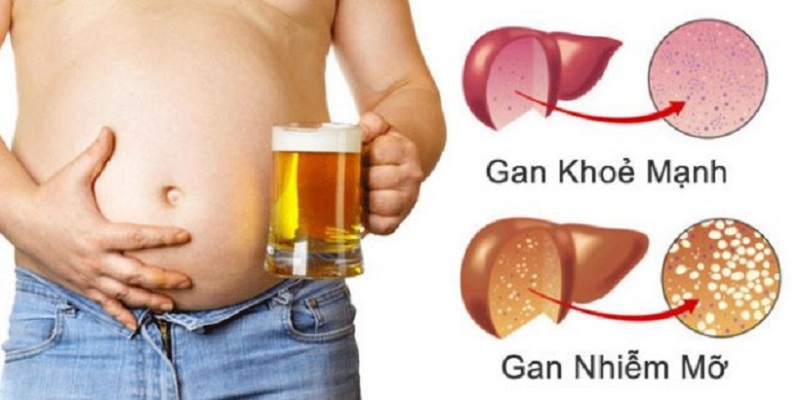 Bệnh gan nhiễm mỡ do rượu bia hoàn toàn không lây nhiễm