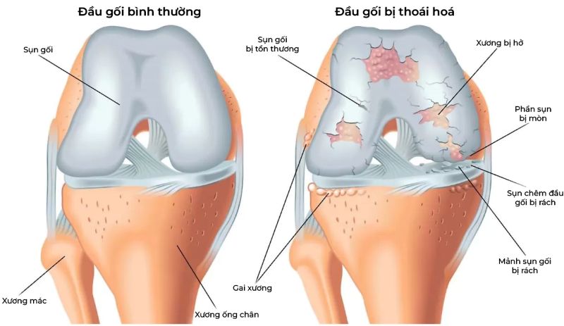Thoái hóa khớp gối cũng khiến đau đầu gối khi co chân