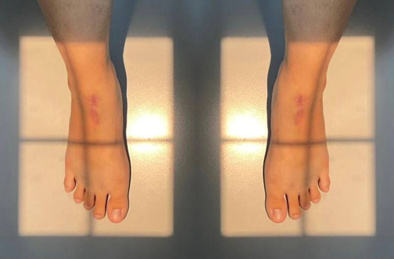 Tại sao người ta thường chụp Xquang xương bàn chân?