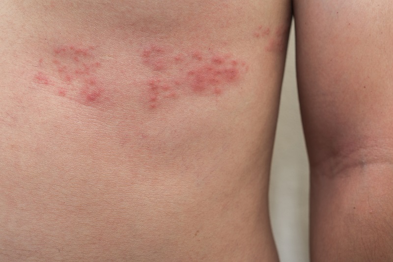 Virus VZV gây hại như thế nào trong cơ thể?
