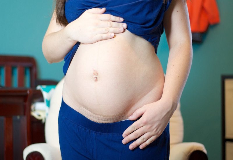 Vết mổ sau sinh có thể nhiễm trùng sau 8 năm không?
