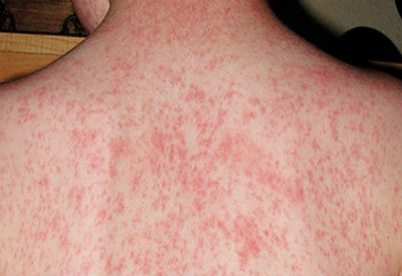 Cách chẩn đoán bệnh sốt phát ban nổi mẩn đỏ?
