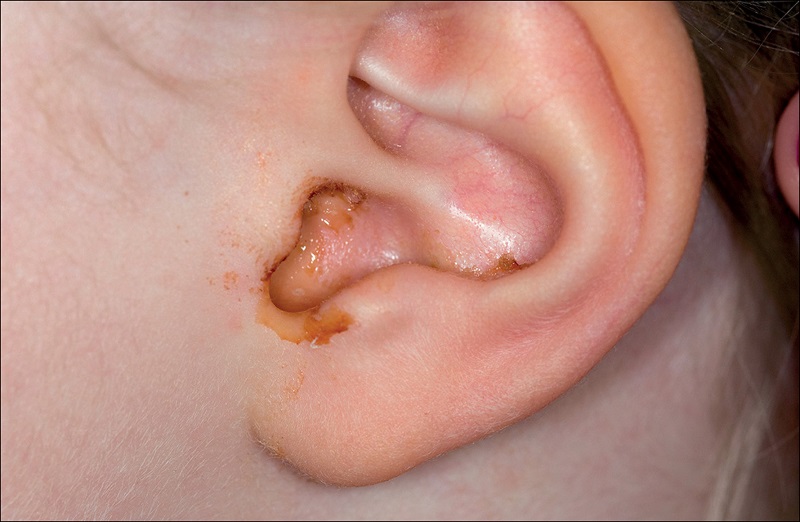 Bú nằm có thể gây viêm tai giữa ở trẻ như thế nào?
