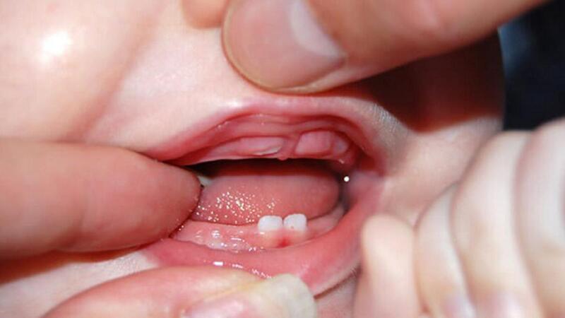 Răng cửa dưới thường mọc lúc nào trong quá trình phát triển của trẻ? 

