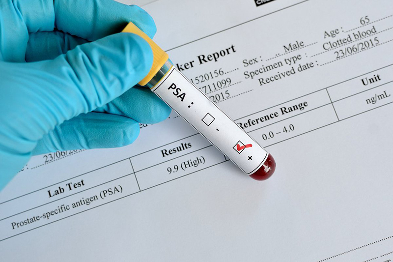 Tìm hiểu về xét nghiệm máu psa là gì và những thông tin bạn cần biết