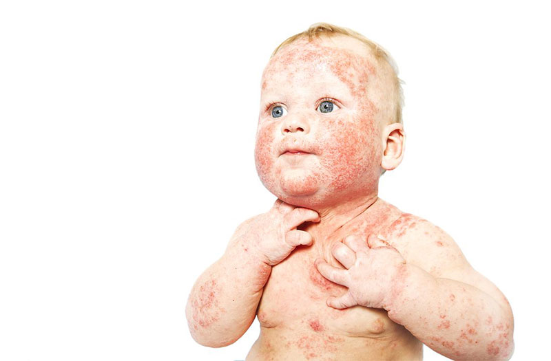 Dị ứng da ở trẻ em có những triệu chứng như thế nào?
