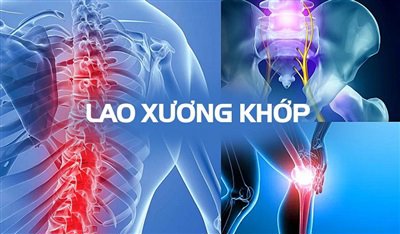 Vi khuẩn lao xâm nhập và phá hủy cấu trúc sụn khớp và xương tại khớp háng