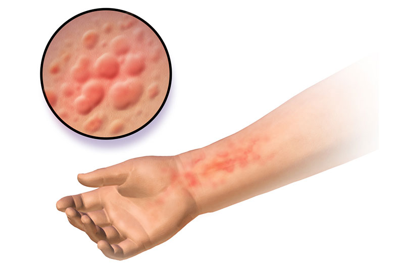 Bệnh gì thường xuất hiện trên da khi trời nóng?
