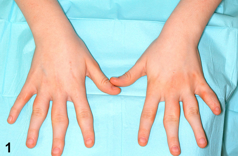 Liệu phương pháp chữa trị tự nhiên có hiệu quả cho viêm khớp tay không?
