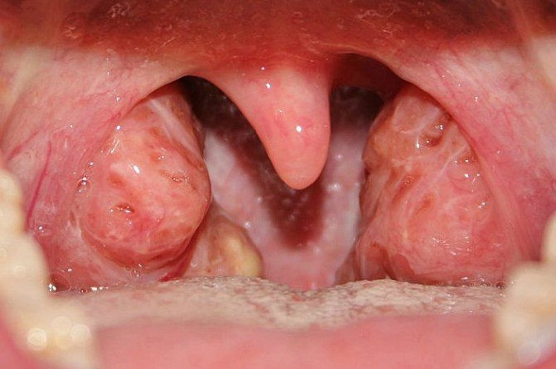 Triệu chứng của đau họng sưng amidan là gì?
