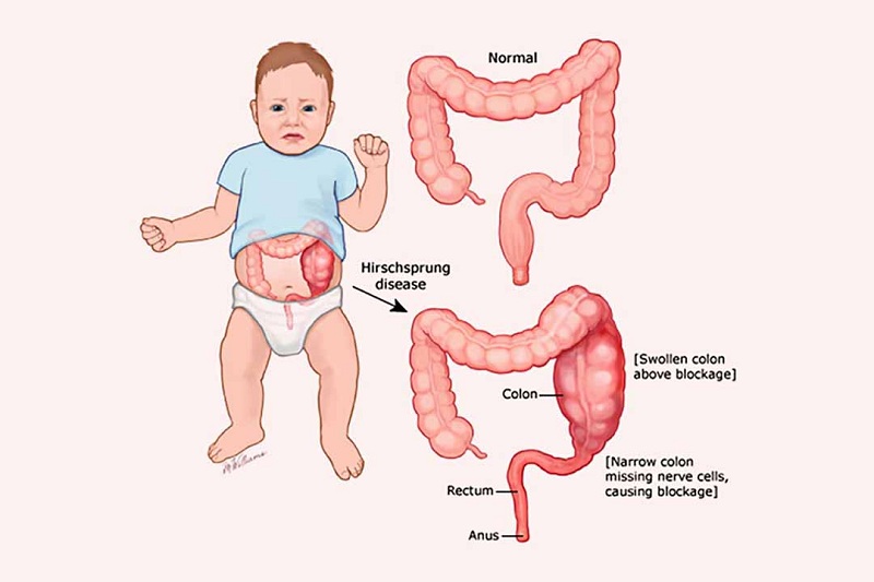 Các yếu tố nguy cơ tăng khả năng mắc viêm ruột hoại tử ở trẻ sơ sinh là gì?
