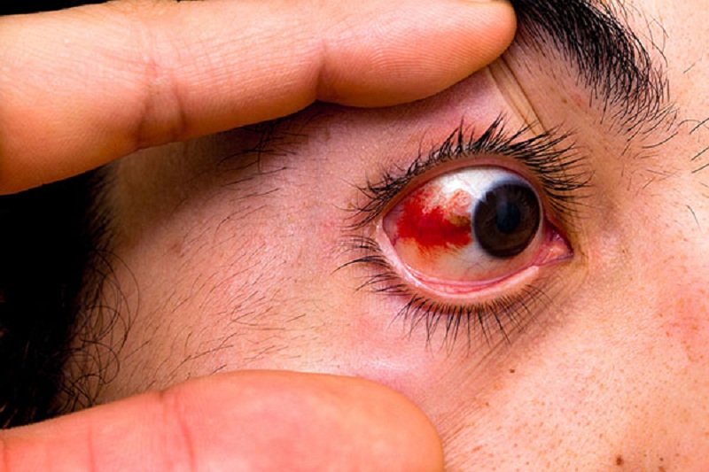 cách trị tan máu bầm ở mắt