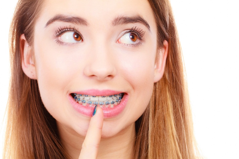 Niềng răng có làm răng bị yếu đi không?