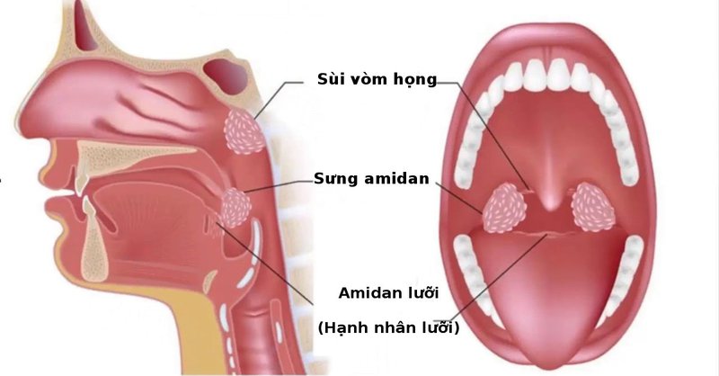 Ai có nguy cơ mắc áp xe amidan?
