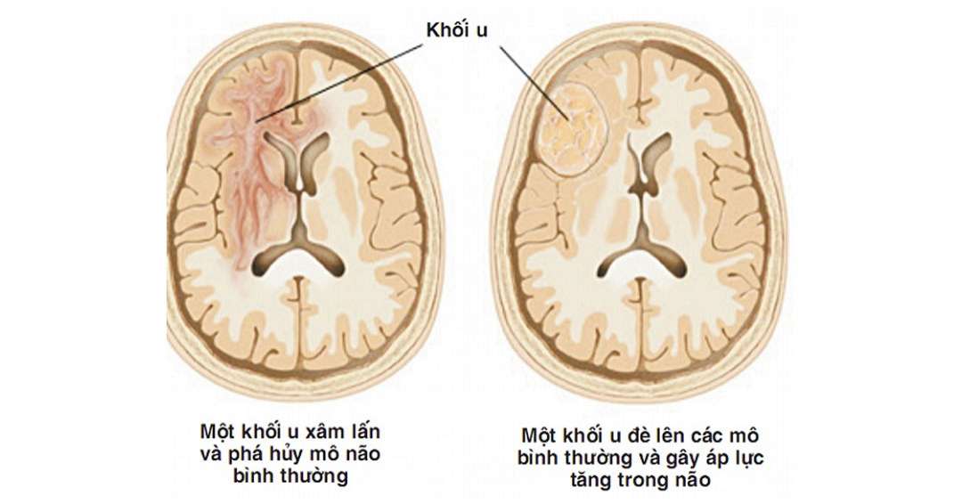 Có những yếu tố gì có thể làm tăng nguy cơ mắc khối u não?
