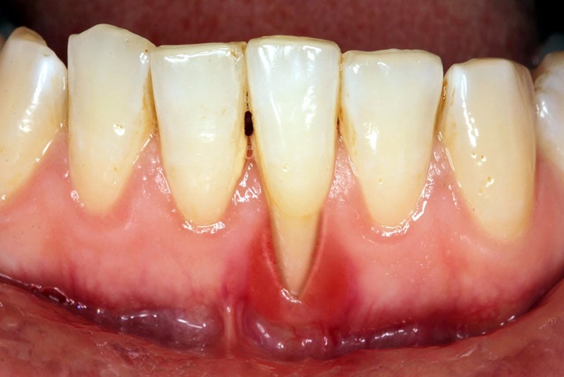 Làm thế nào để phòng ngừa răng yếu lung lay?
