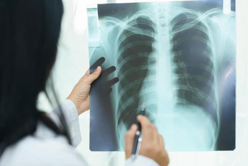 Xơ phổi có chữa được không và lối sống khoa học cho bệnh nhân