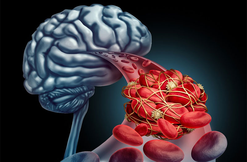 Triệu chứng chính của bệnh mạch máu não là gì?
